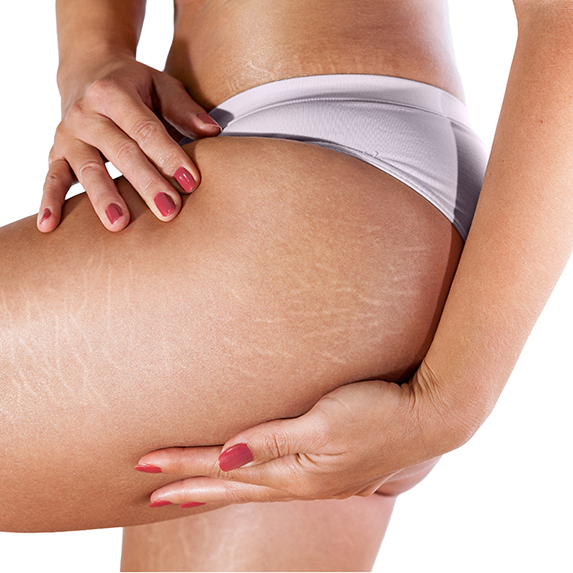 Stretch marks on woman's thighs and buttocks