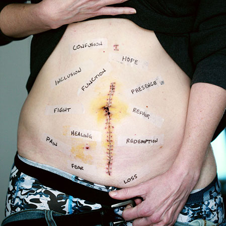 A stomach with negative words written all over it as well as a surgical scar