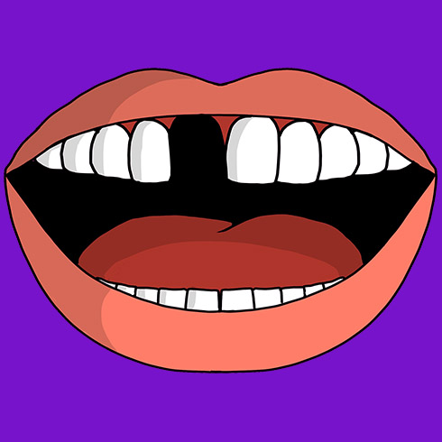 Illustration of a mouth missing a tooth